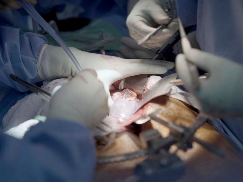 Dan de alta al primer paciente trasplantado con un riñón de cerdo en Boston