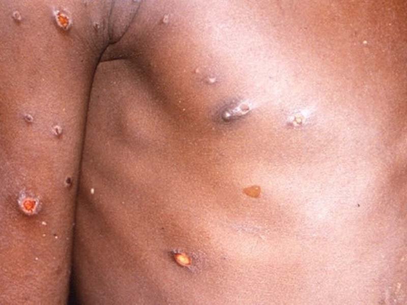 España registra 7 casos de viruela del mono todos de la antigua variante y el 98 % en hombres